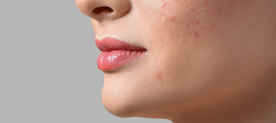 Open Pores: Causes and Skincare Products to Minimize Them